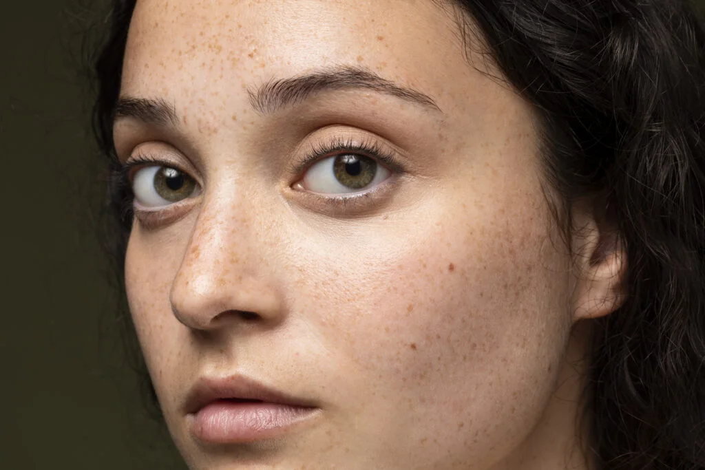 Banishing Blackheads: Unveiling Causes, Prevention, and Effective Treatments